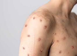 368 casos de viruela símica en Jalisco