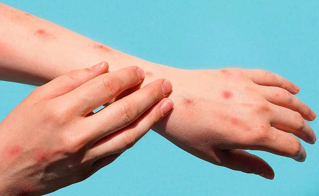 En México se confirmaron las primeras cuatro muertes relacionadas con la viruela del mono; hay pruebas para detectar este virus
