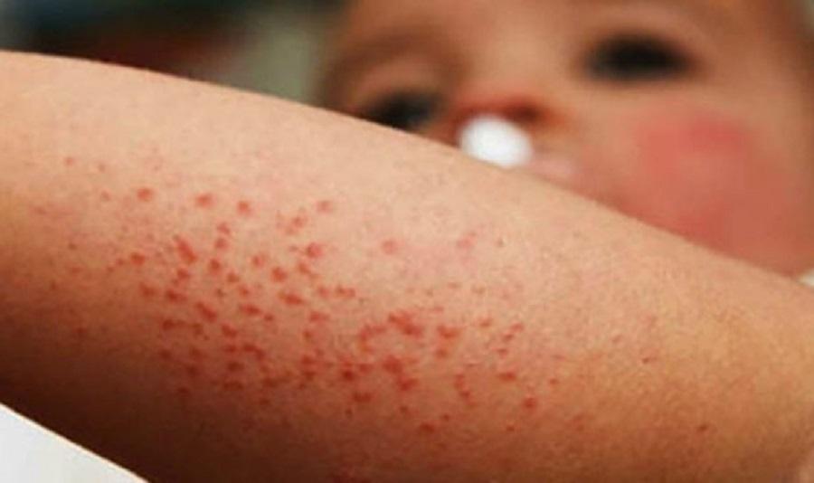 OMS alerta sobre fuerte aumento de casos de sarampión en el mundo