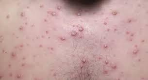 Registra Jalisco cero casos nuevos de Mpox en la última semana