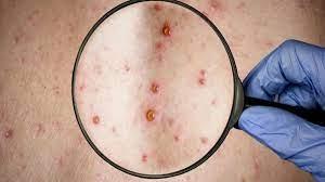 Confirman 13 casos nuevos de Viruela Símica en Jalisco; suman ya 46