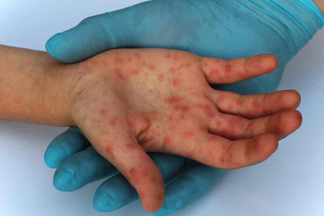 Jalisco suma 43 casos de Sarampión