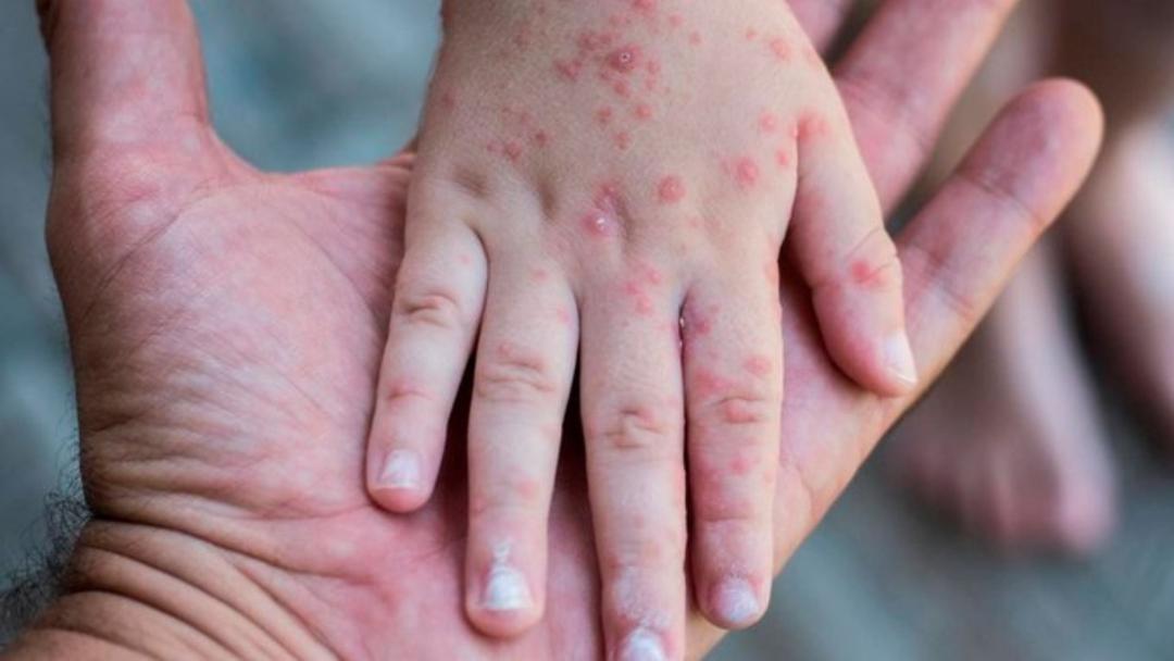 Sarampión en México: Confirman segunda muerte en CDMX; era un bebé de 7 meses