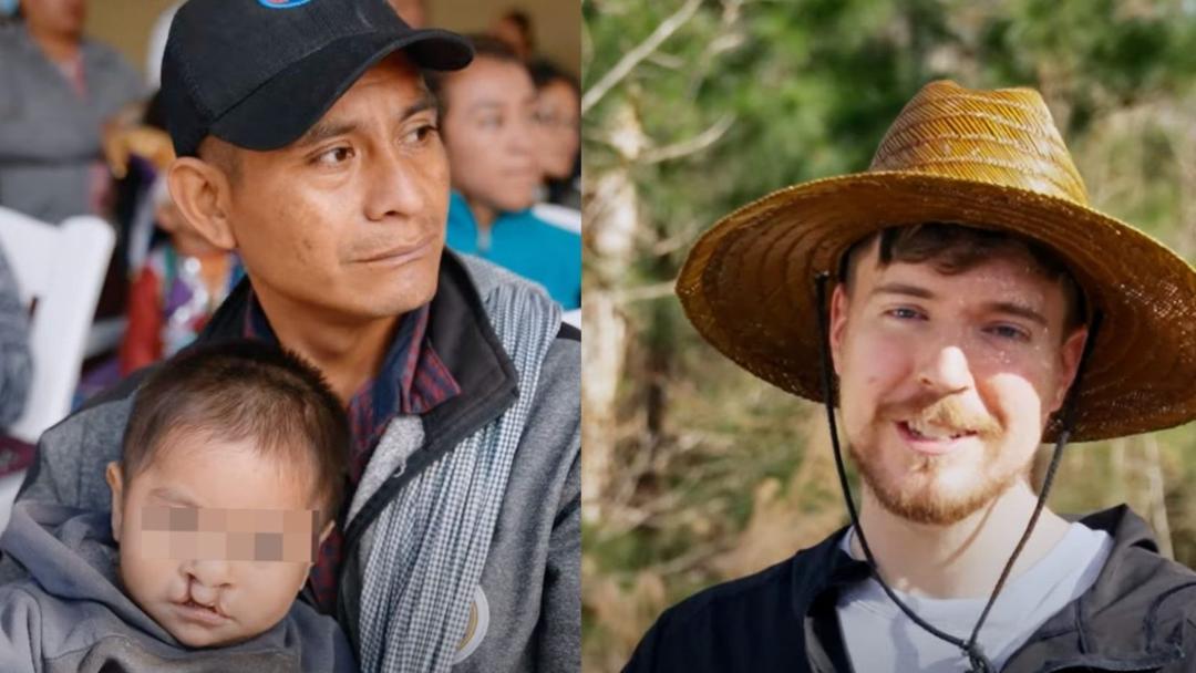 Mr. Beast regaló más de 100 cirugías a niños mexicanos con labio leporino