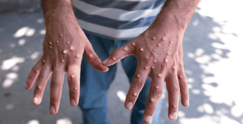 Viruela del Mono: Detectan nueva cepa del virus mutante; podría generar pandemia