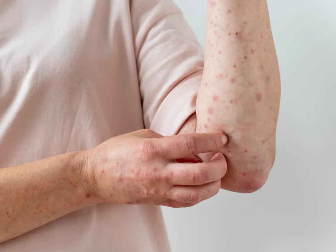 Sarampión: Aumentan a 421 los casos en México