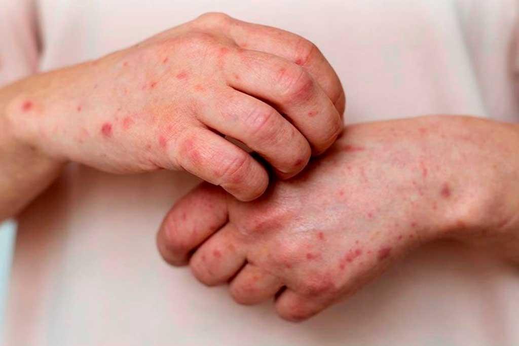 Mpox: Se registra la primera muerte en Jalisco por la enfermedad