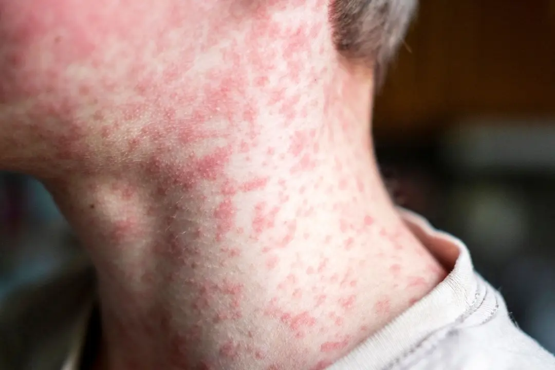 Tlaquepaque lanza campaña de vacunación contra el sarampión