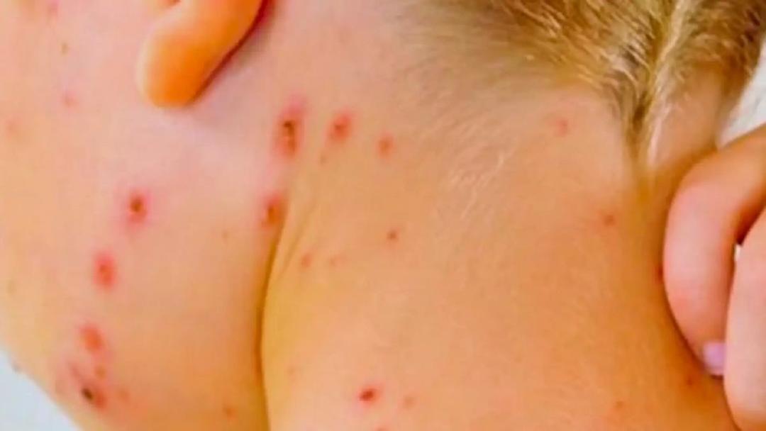 Sarampión en Jalisco: Suman 231 casos; 16 en las últimas horas