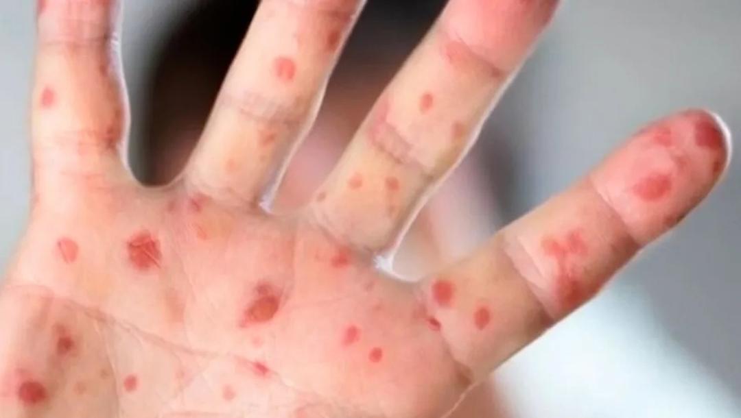 Sarampión: México registra casi 6 mil casos; habría 24 muertos