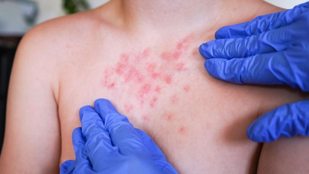 Sarampión en Jalisco: Refuerza vacunación con apoyo en escuelas y empresas