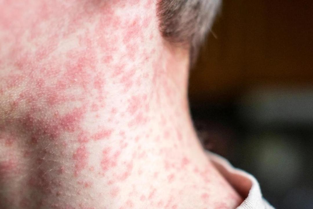 Jalisco intensifica vacunación masiva contra el sarampión