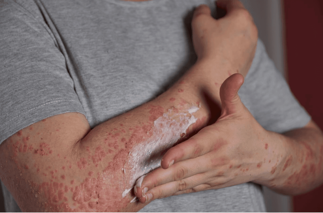 Sarampión en México: Hay un virus atípico; esta es la diferencia