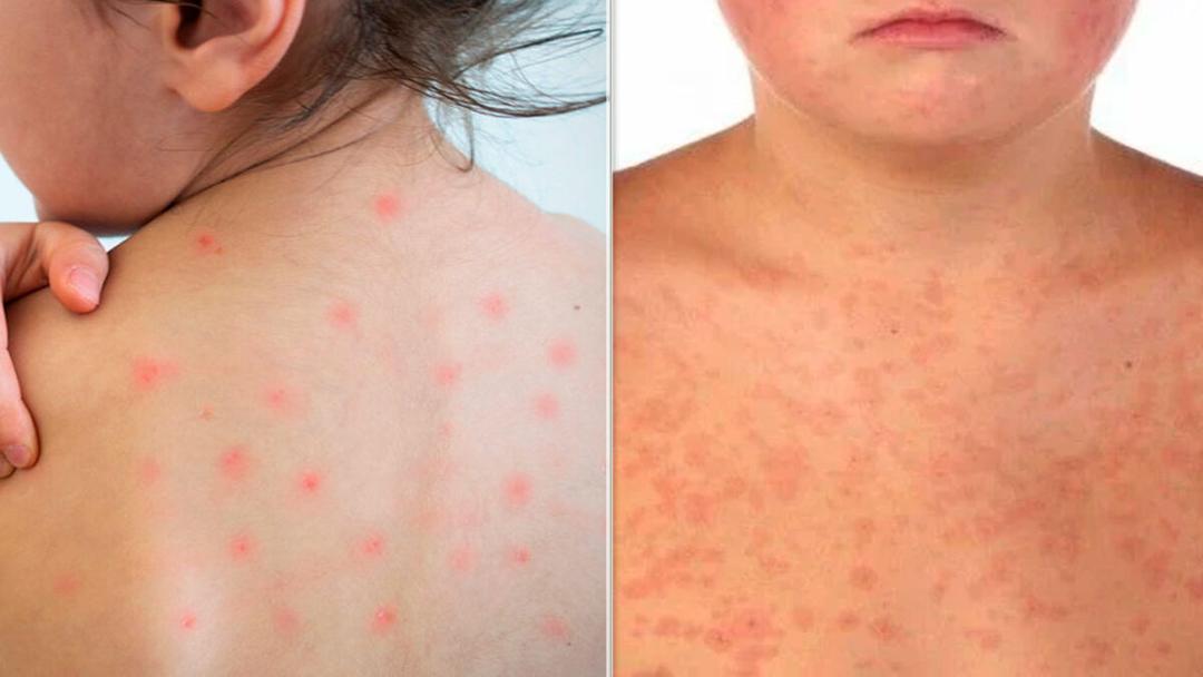 Sarampión en México: Detectan primer caso en Reynosa