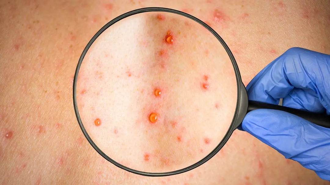 Sinaloa: Se registra primera muerte por sarampión