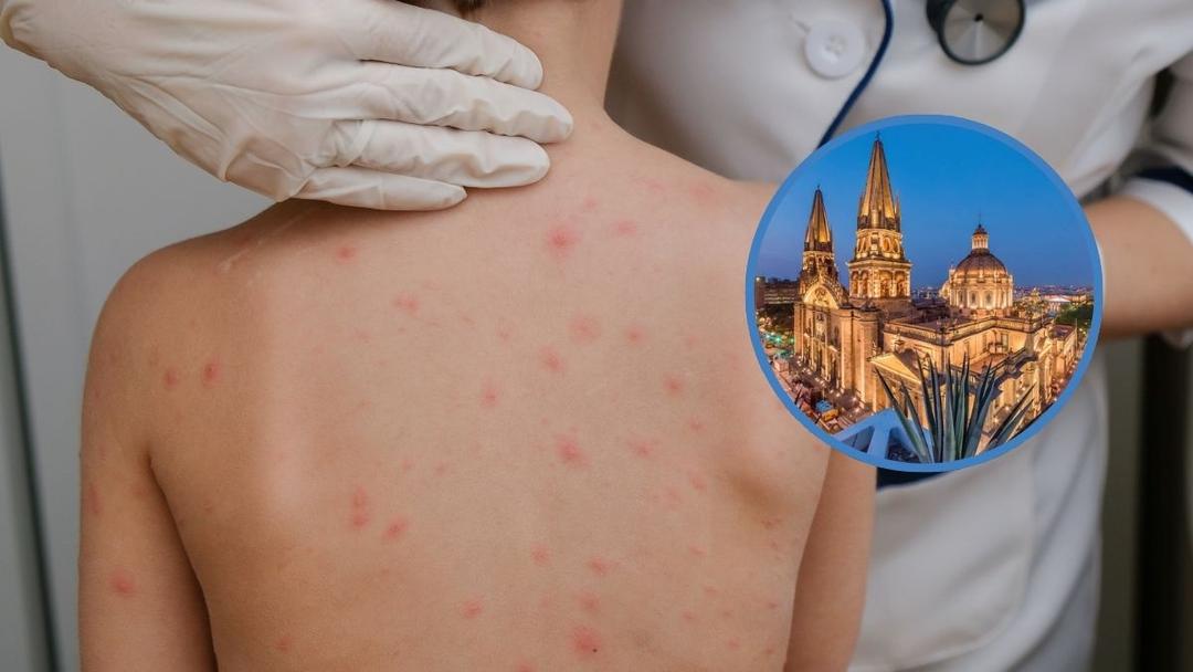 Sarampión en Jalisco: Casos van a la baja en la entidad