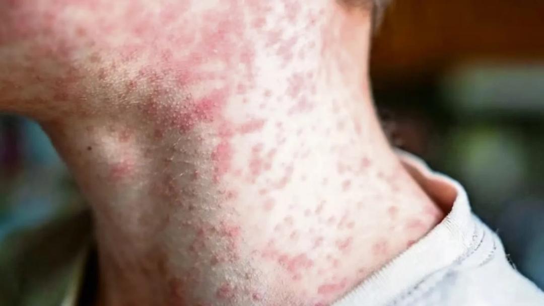 Sarampión en Jalisco: Suman cuatro fallecimientos por casos